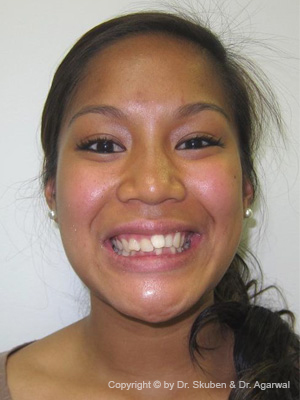 Brante had a gum surgery, tooth bonding and orthodontic treatment. She was ecstatic with the results.