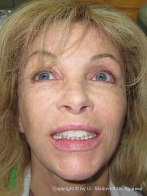 Silvia wanted a big smile to look young and beautiful. She got a full smile makeover with crowns and a dental implant.