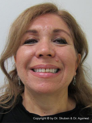 Martha had multiple fillings which were discolored. She wanted a smile makeover and loved her smile.
