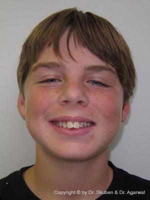 Dylan had Orthodontic treatment done and loves his smile.
