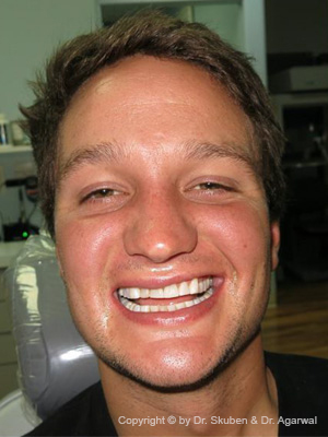 Casey had severe teeth wear problems which were corrected with a smile makeover. Casey is a handsome and a confident young man now.