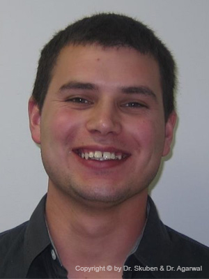 Travis had a full smile makeover with crowns for aesthetics and orthodontics for bite correction.