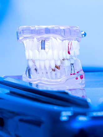 dental implants